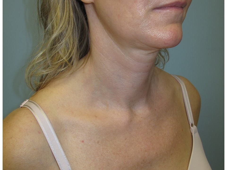 VelaShape III for the neck After