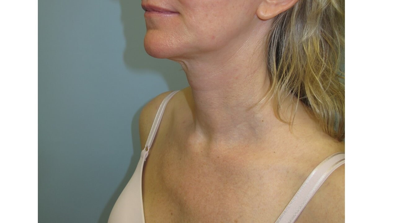 VelaShape III for the neck After