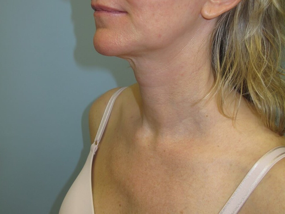 VelaShape III for the neck After