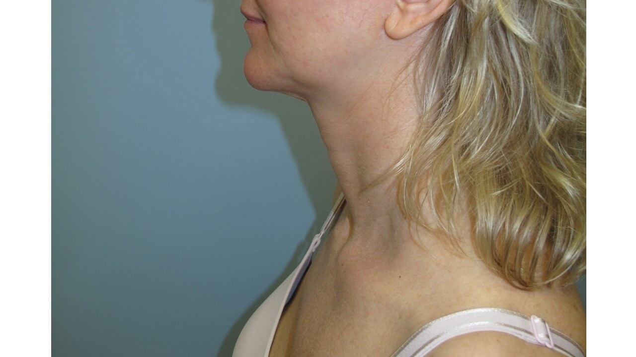 VelaShape III for the neck After