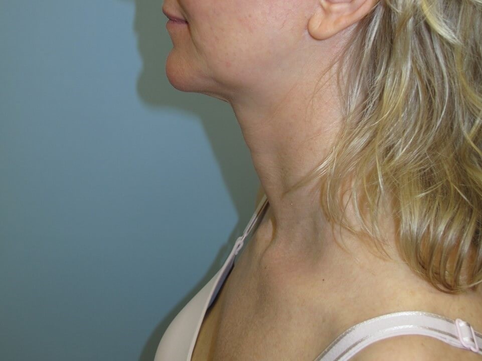 VelaShape III for the neck After