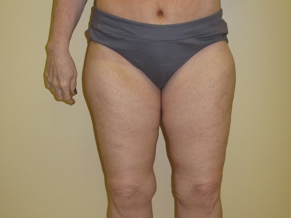 Thigh Lift After
