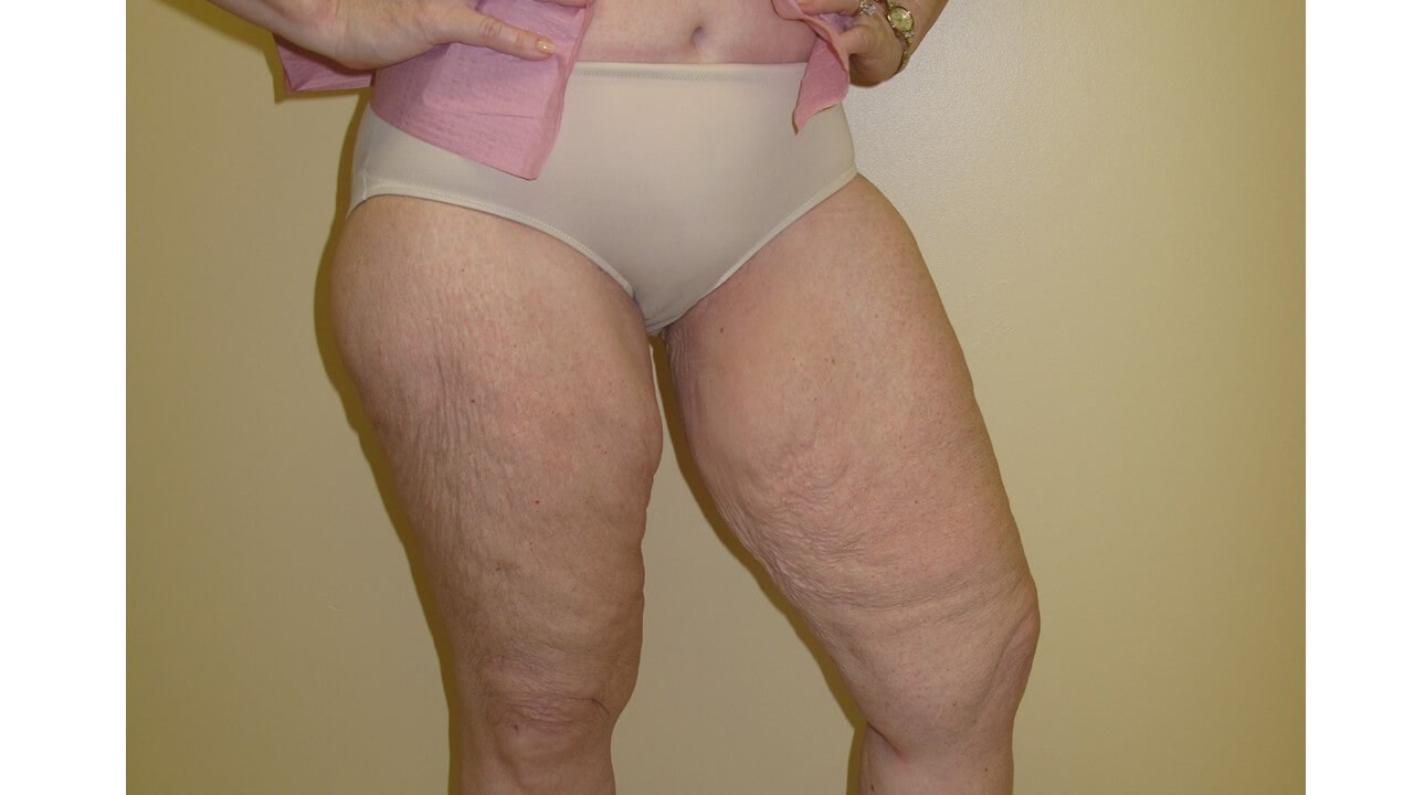 Thigh Lift Before