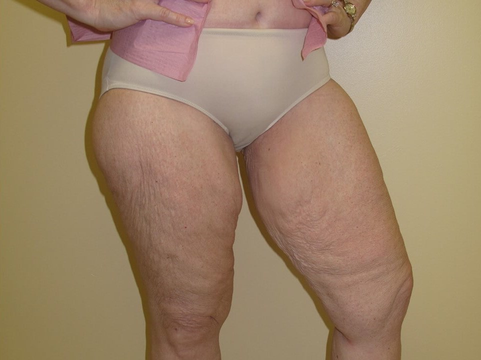 Thigh Lift Before