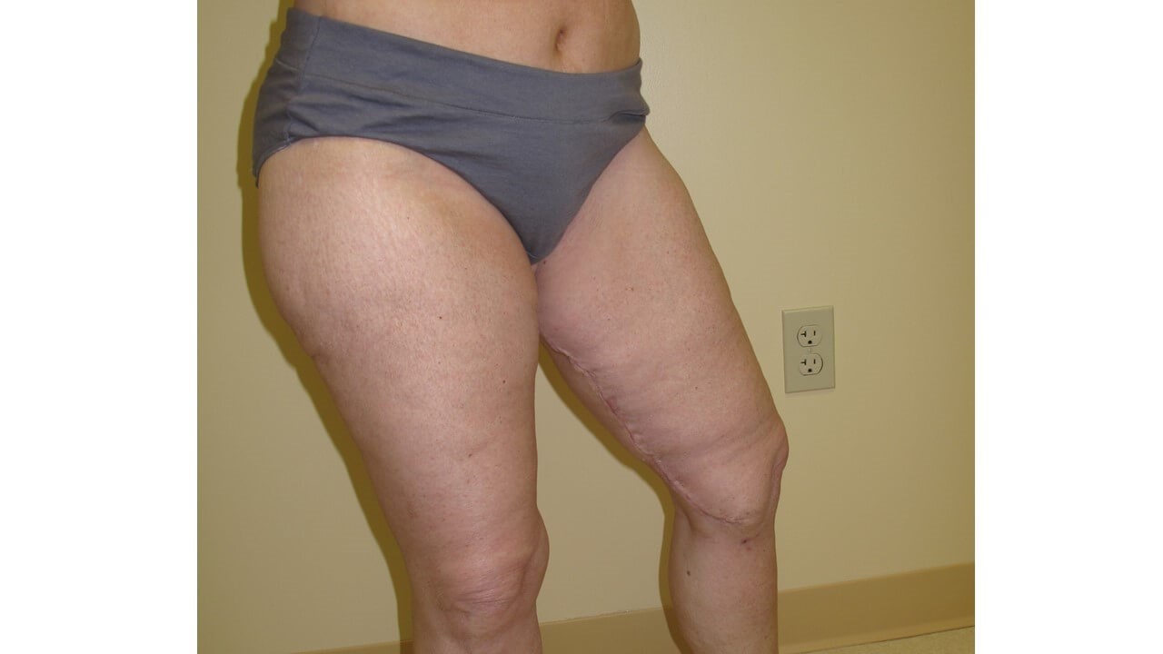 Thigh Lift After
