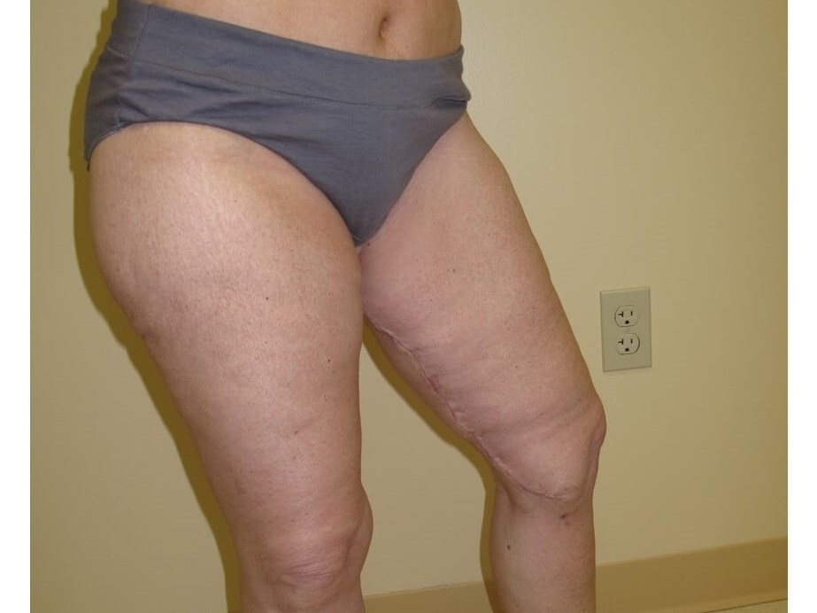 Thigh Lift After