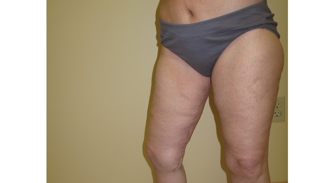 Thigh Lift After