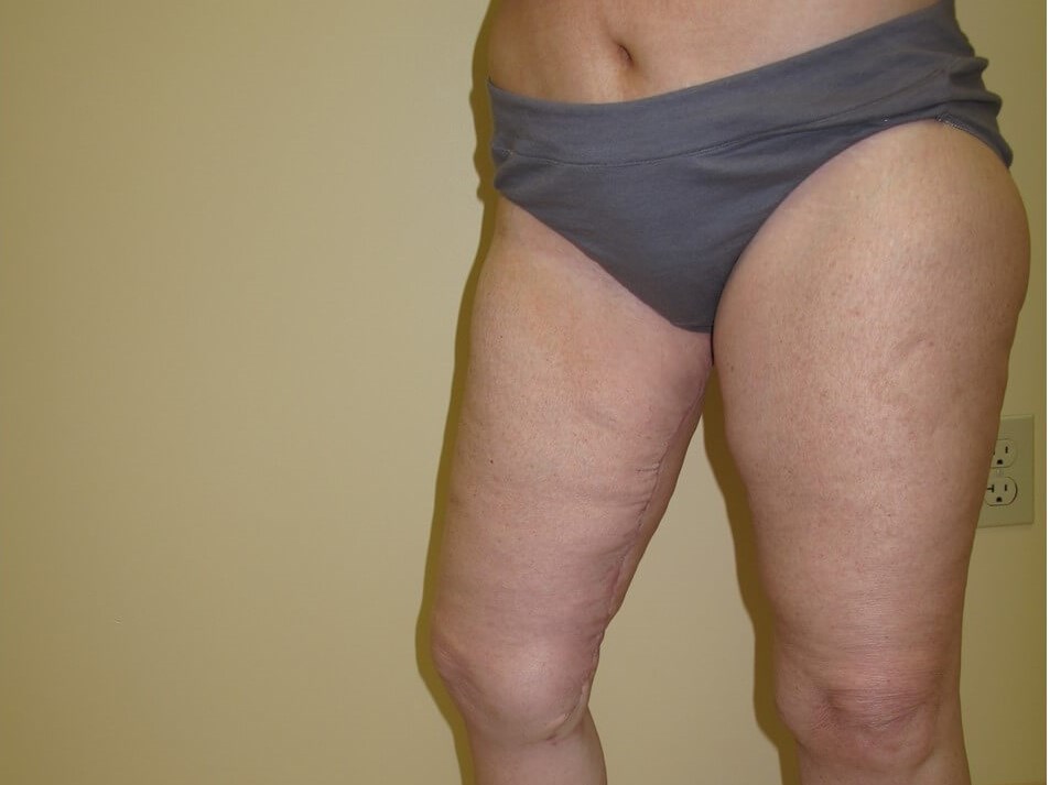 Thigh Lift After