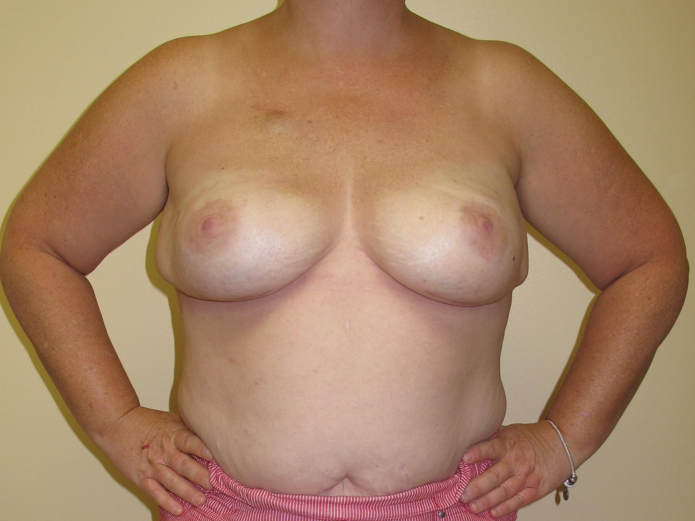 Breast Reconstruction After