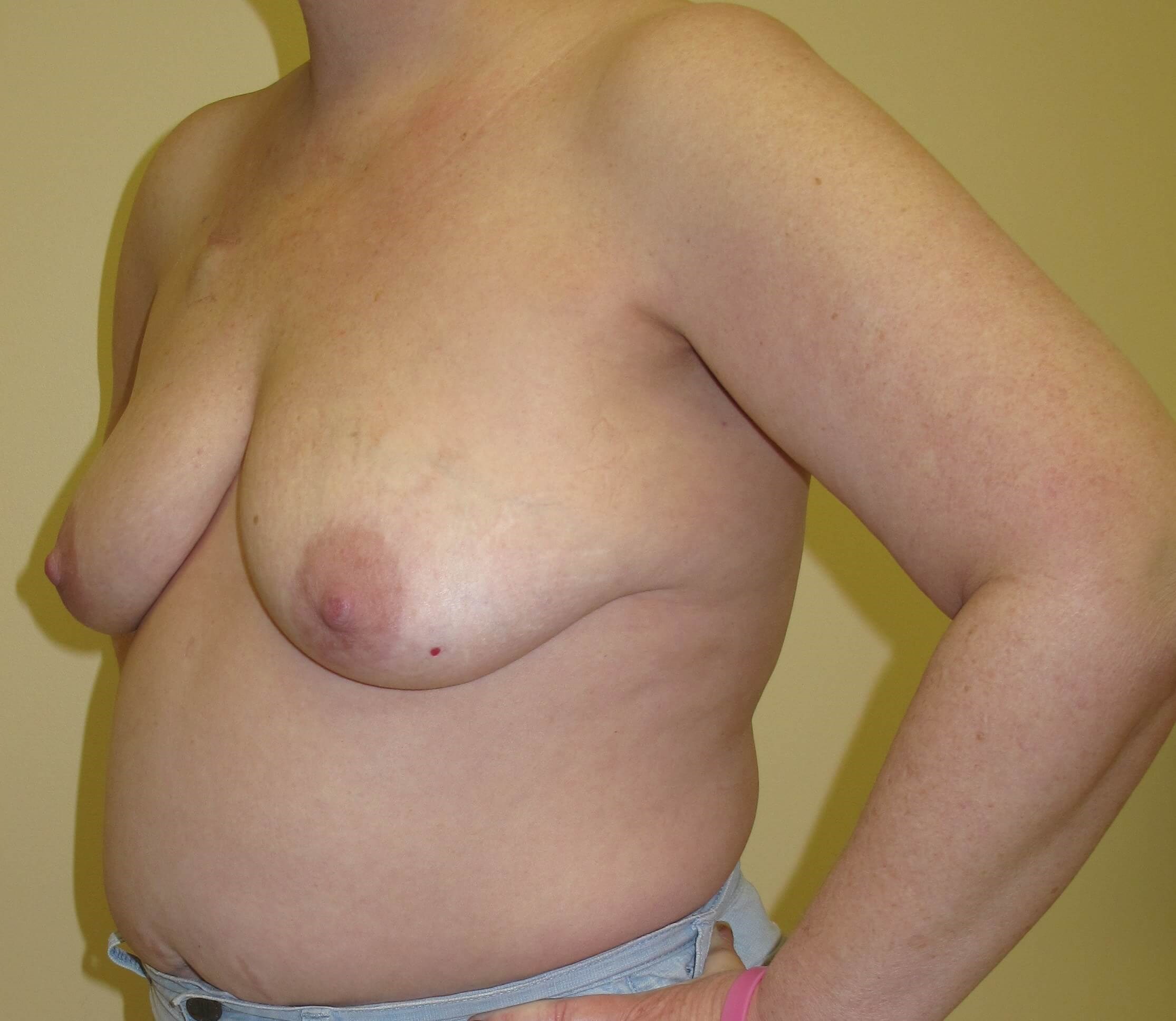 Breast Reconstruction Before