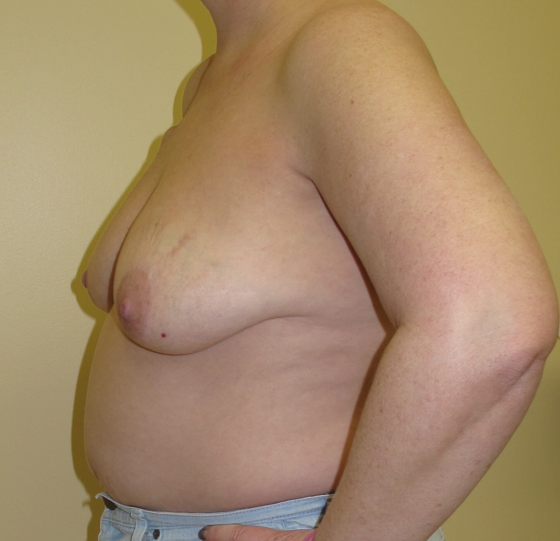 Breast Reconstruction Before