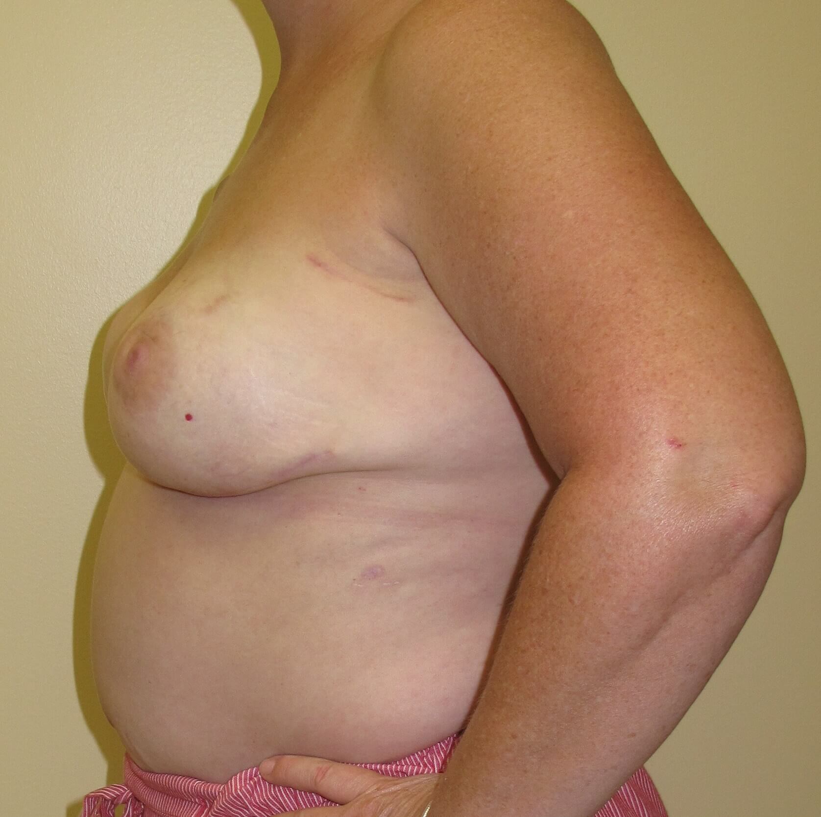 Breast Reconstruction After