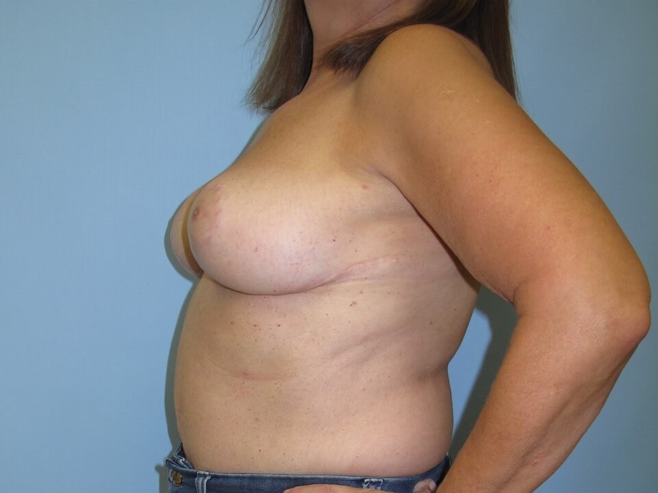 Reduction Mammoplasty After