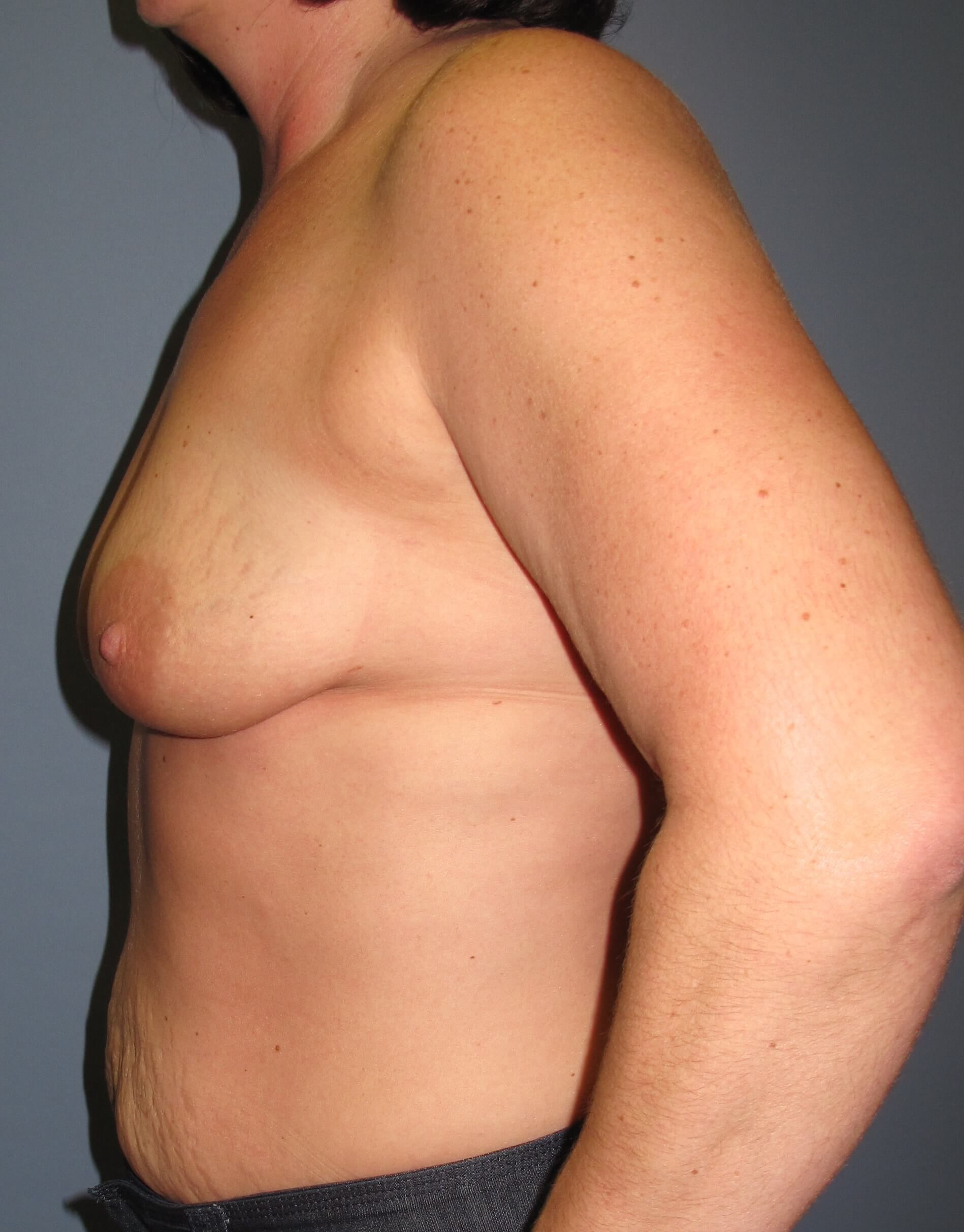 Breast Augmentation Before