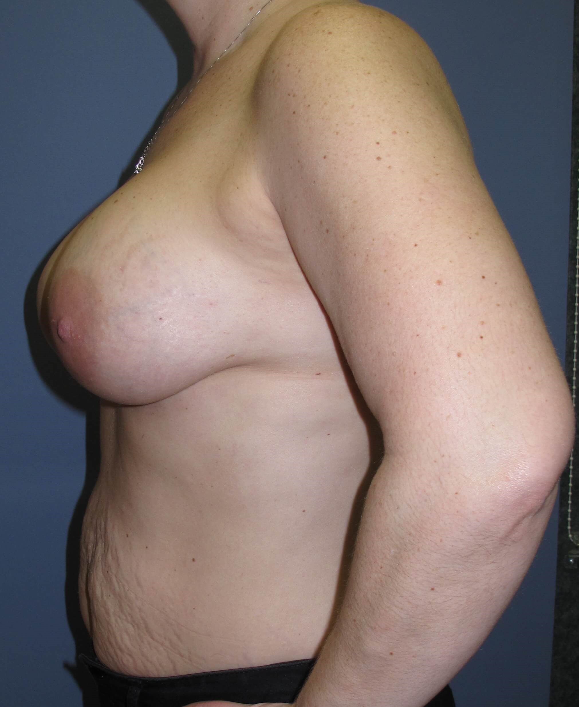 Breast Augmentation After