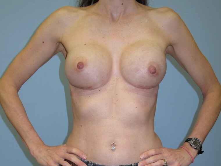 Breast Reconstruction After (Front)
