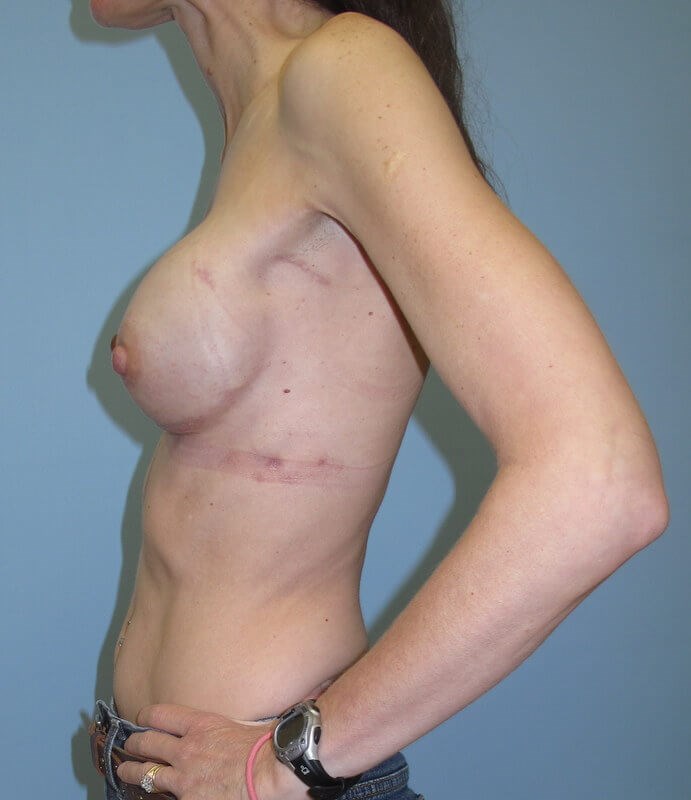 Breast Reconstruction After (Side View)