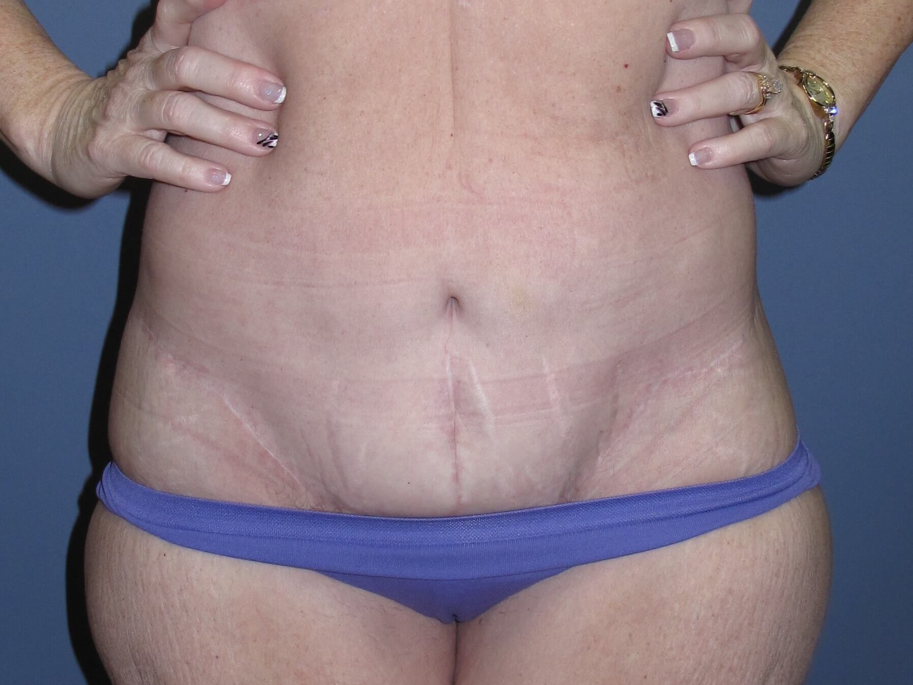 Abdominoplasty After