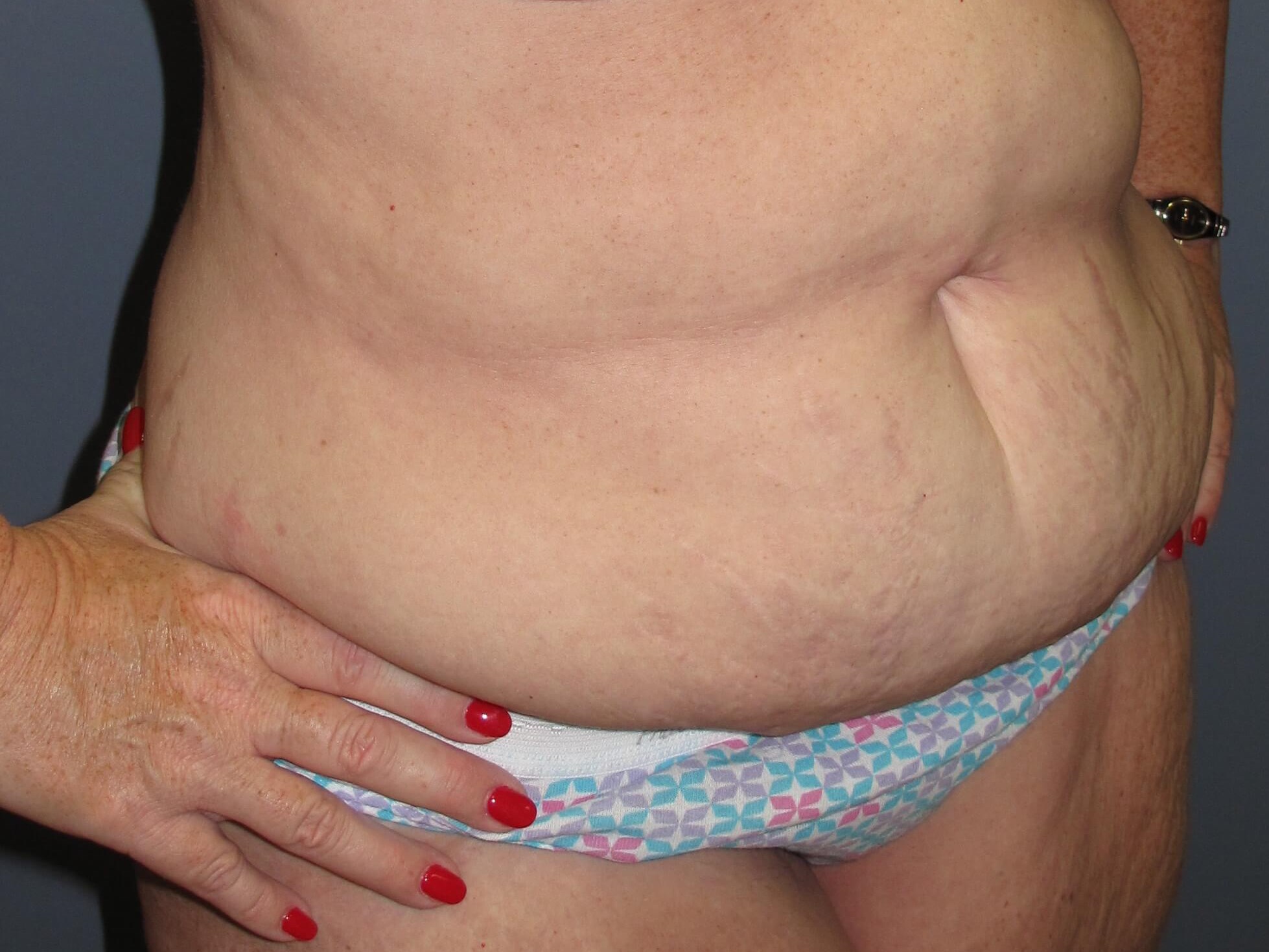 Abdominoplasty Before