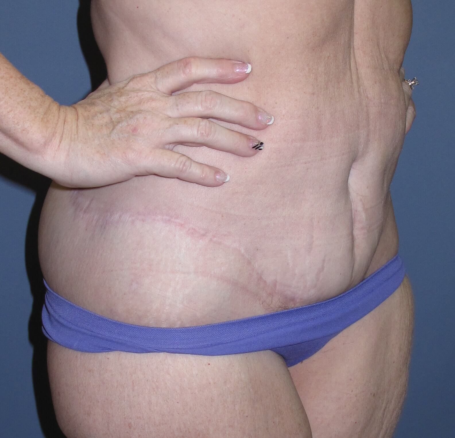 Abdominoplasty After