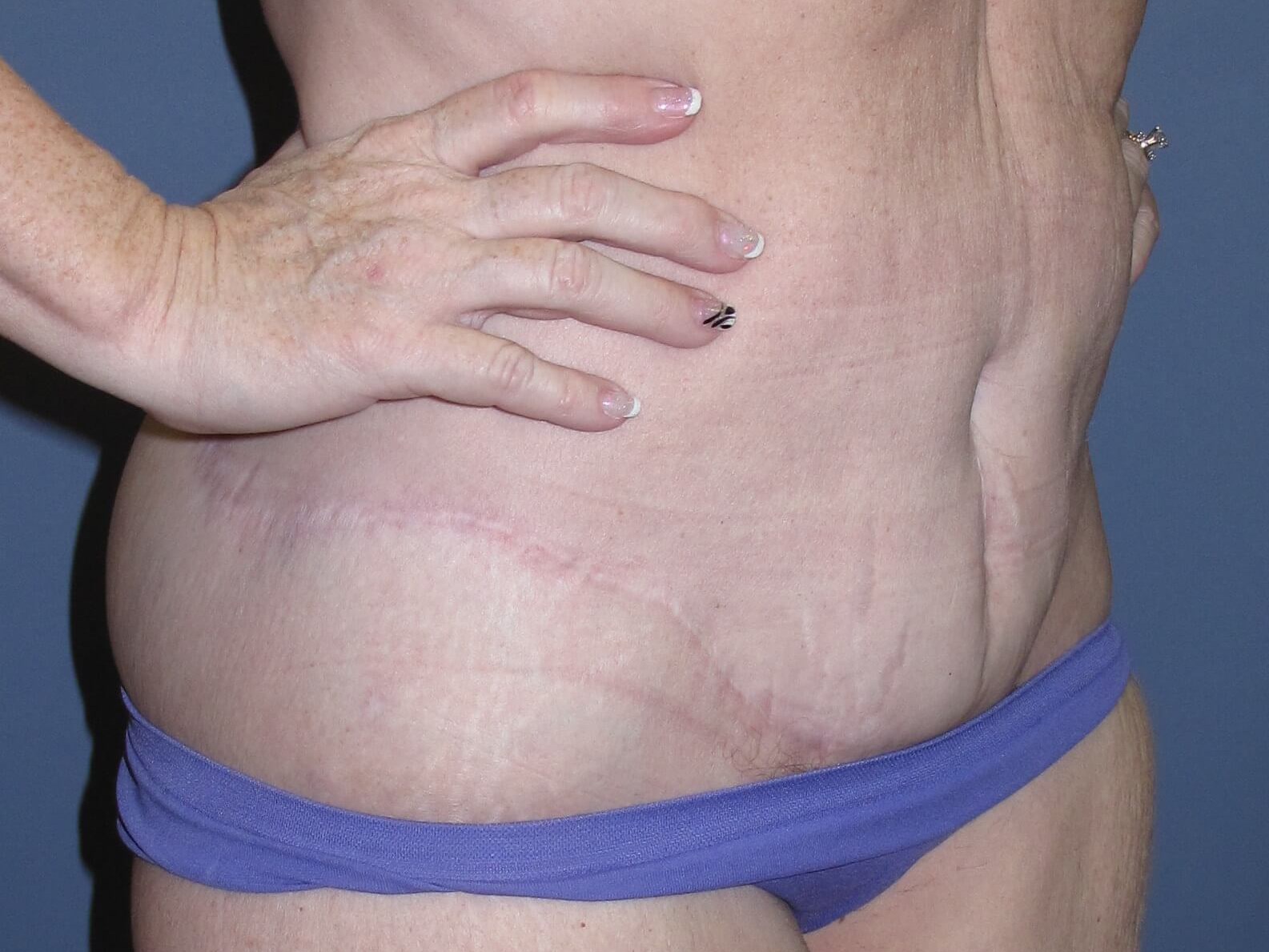 Abdominoplasty After