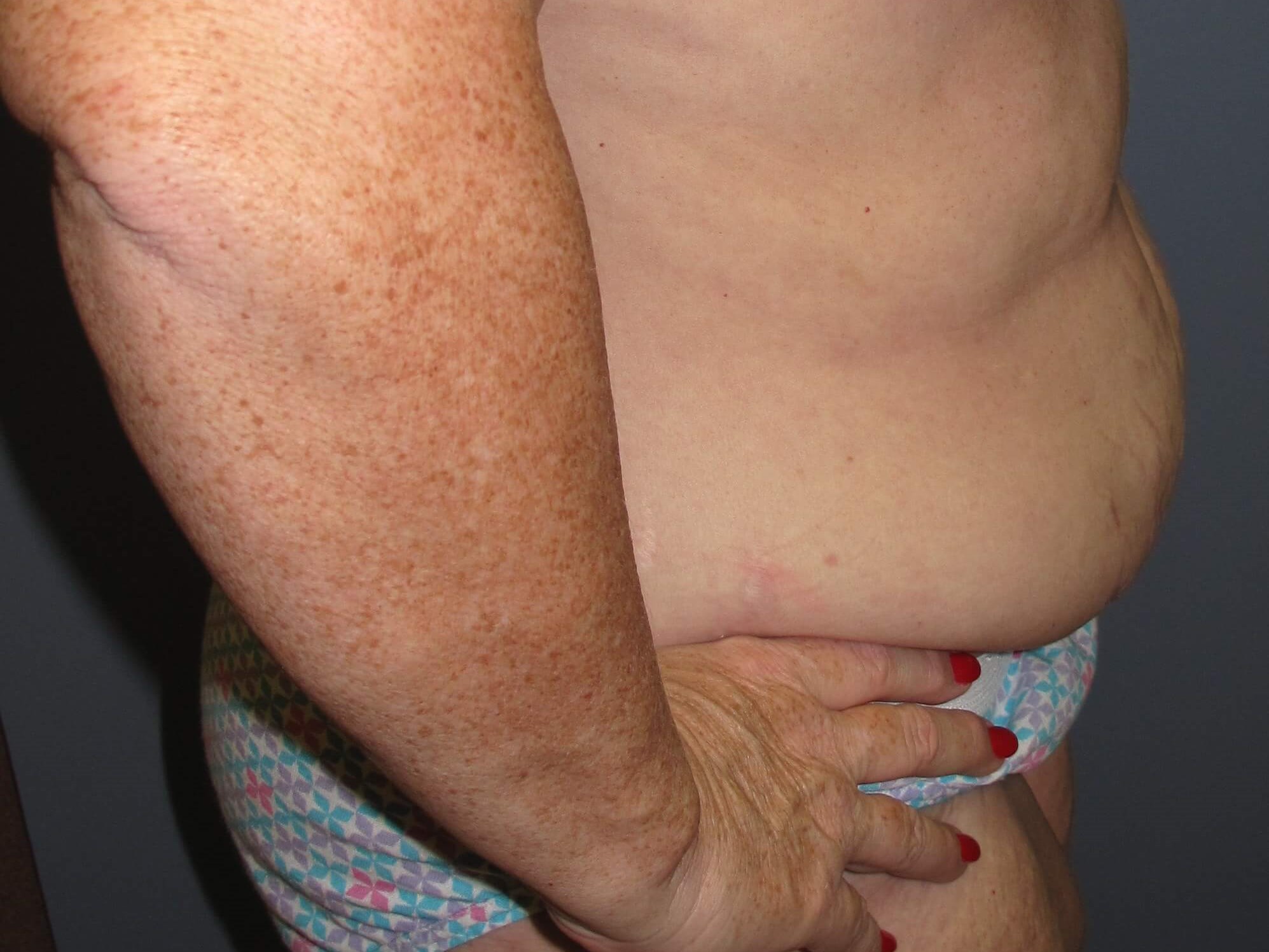 Abdominoplasty Before