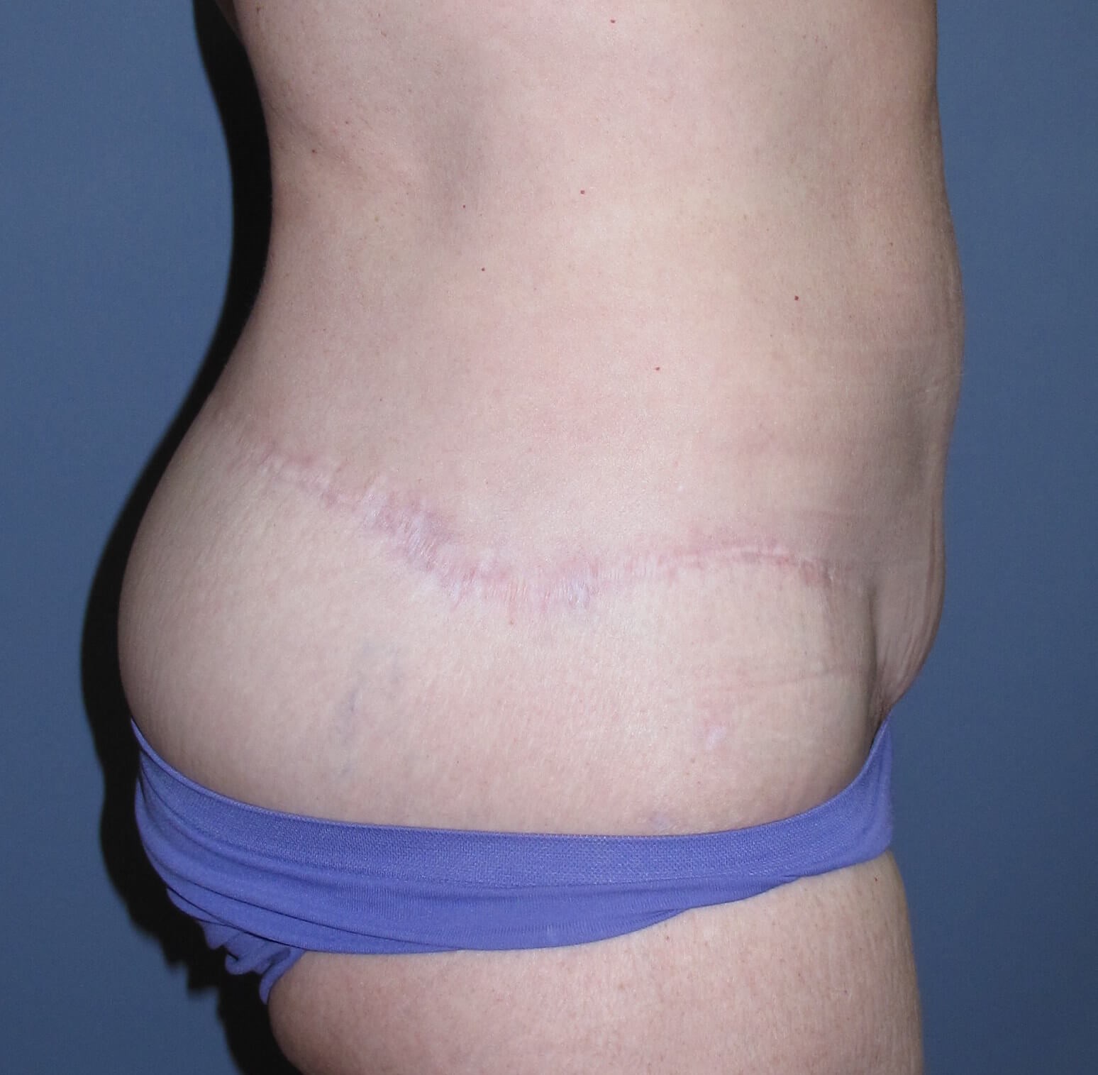Abdominoplasty After