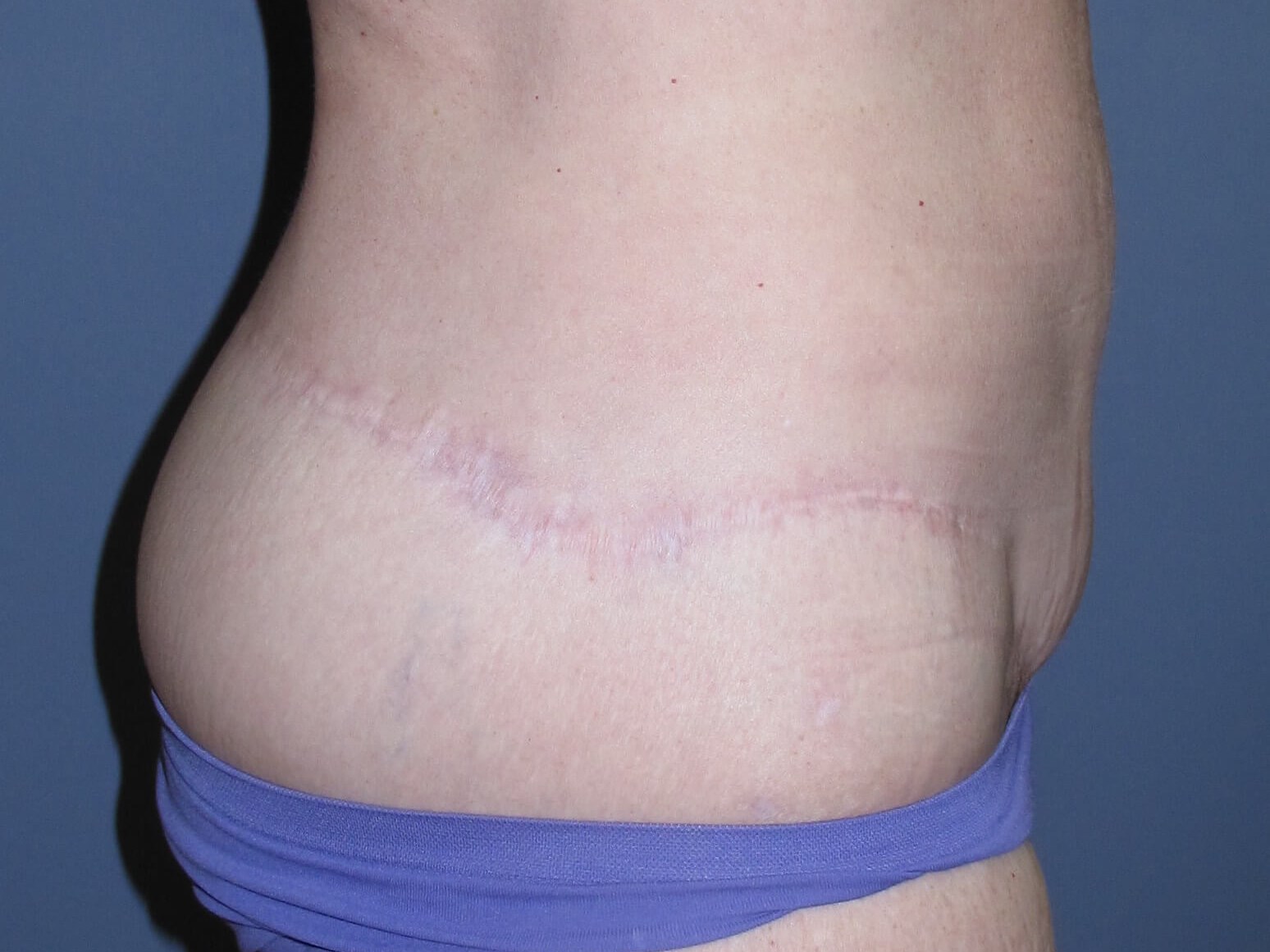 Abdominoplasty After
