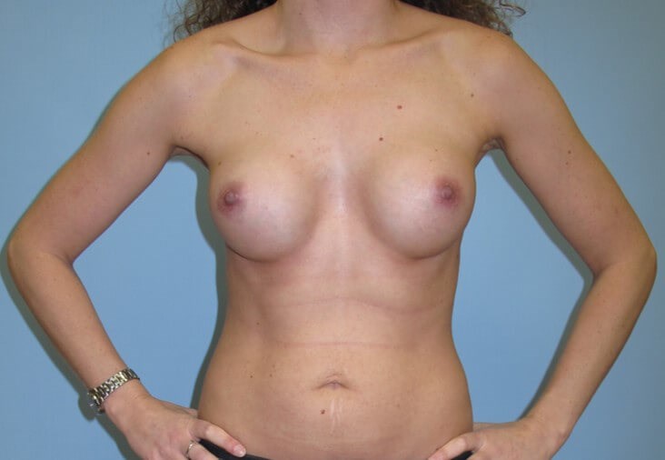 Breast Augmentation After