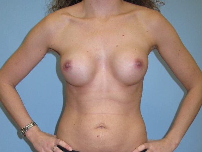Breast Augmentation After