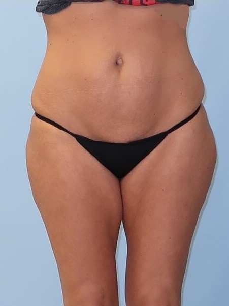 UltraShape Power/VelaShape III After (Front view)
