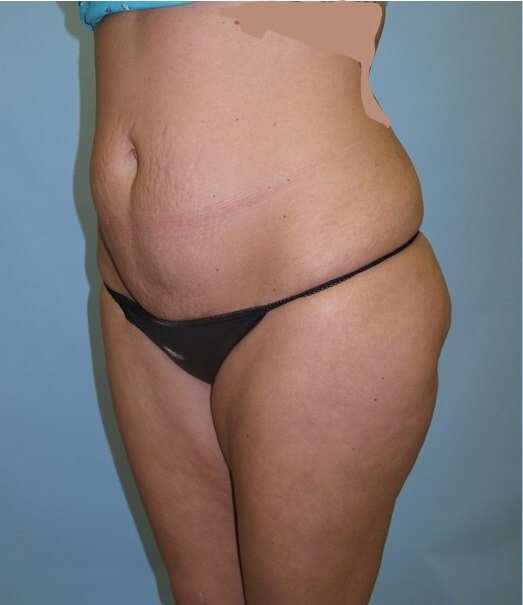 UltraShape Power/VelaShape III Before (Oblique View)