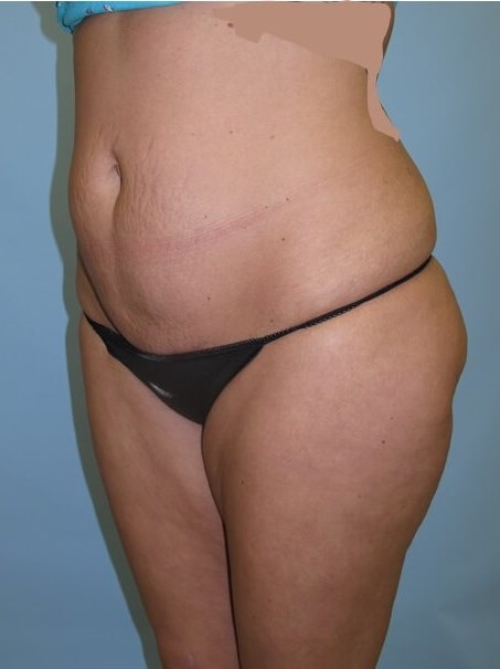 UltraShape Power/VelaShape III Before (Oblique View)