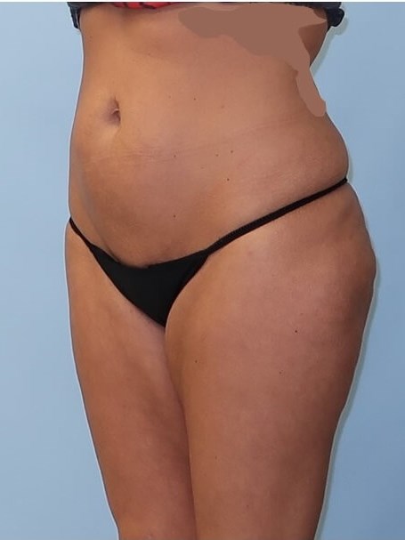 UltraShape Power/VelaShape III After (Oblique View)