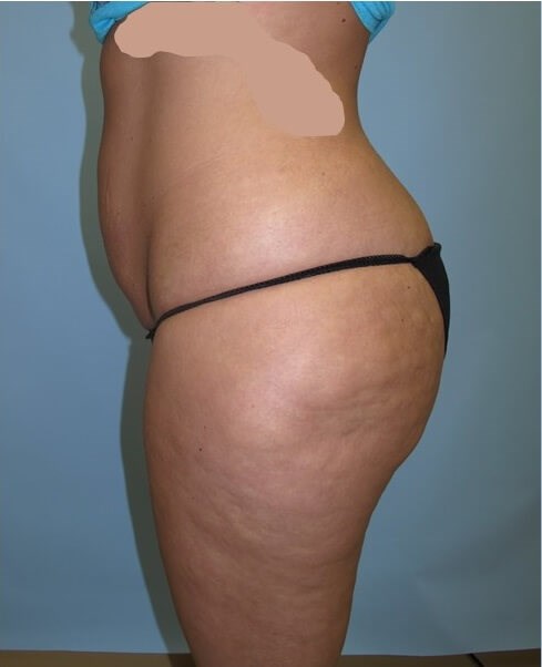 UltraShape Power/VelaShape III Before (Side View)