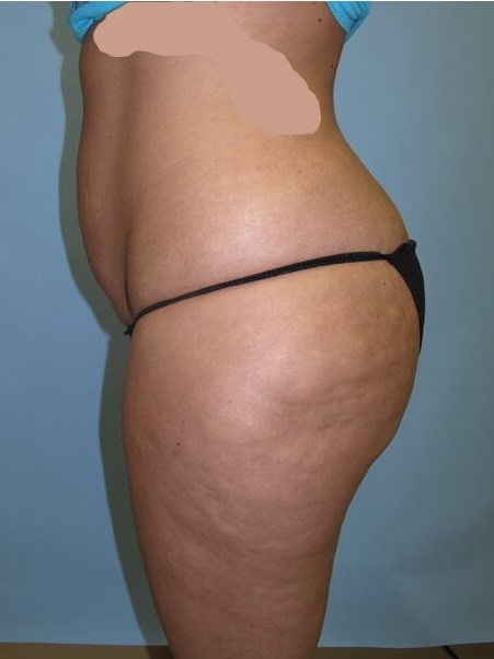 UltraShape Power/VelaShape III Before (Side View)