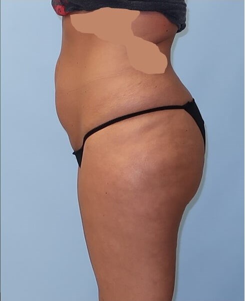 UltraShape Power/VelaShape III After (Side View)