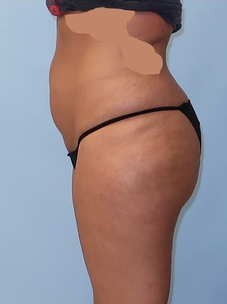 UltraShape Power/VelaShape III After (Side View)