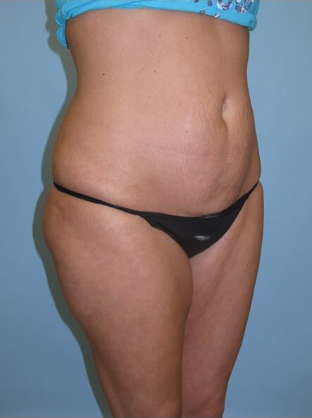 UltraShape Power/VelaShape III Before (Oblique View)