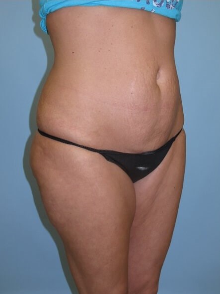 UltraShape Power/VelaShape III Before (Oblique View)