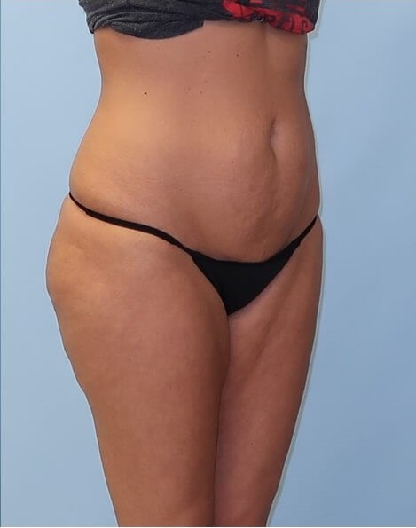 UltraShape Power/VelaShape III After (Oblique View)