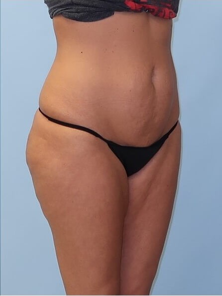 UltraShape Power/VelaShape III After (Oblique View)