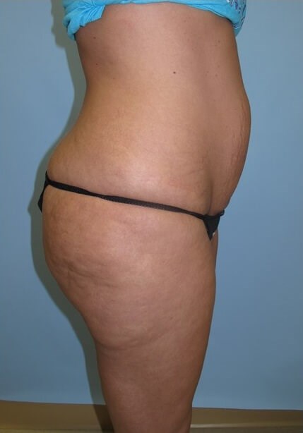 UltraShape Power/VelaShape III Before (Side View)