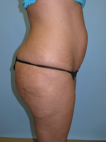 UltraShape Power/VelaShape III Before (Side View)