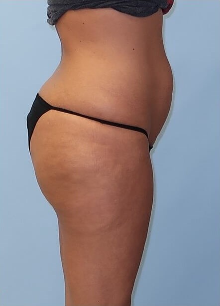 UltraShape Power/VelaShape III After (Side View)