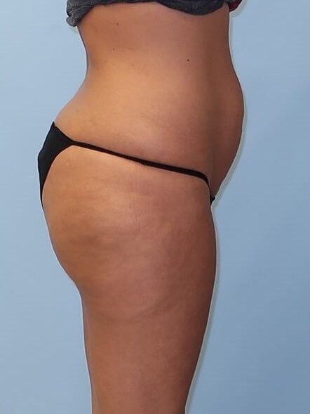 UltraShape Power/VelaShape III After (Side View)
