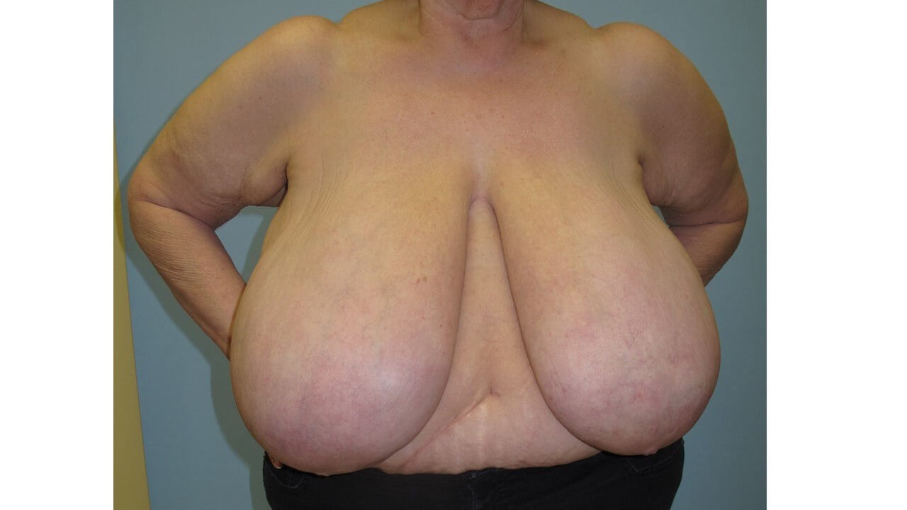 Bilateral Breast Reduction Before