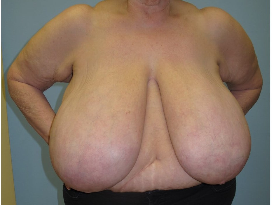 Bilateral Breast Reduction Before