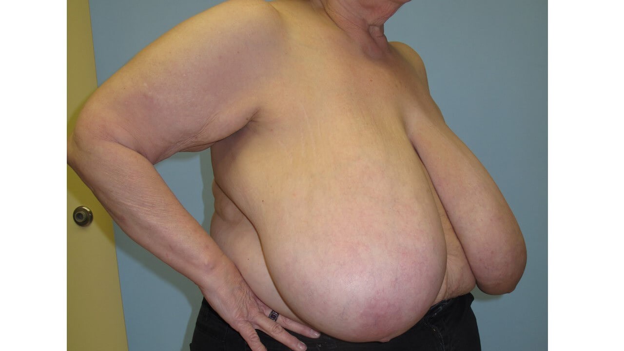 Bilateral Breast Reduction Before