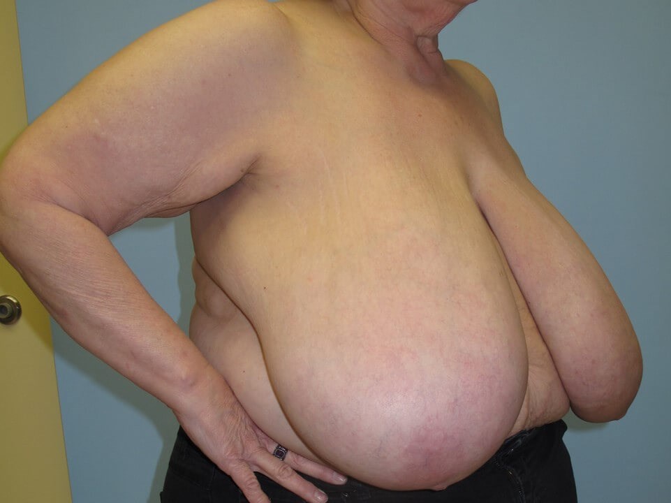 Bilateral Breast Reduction Before
